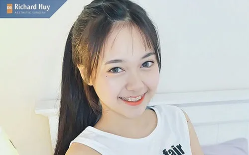 Niềng giăng giúp khắc phục mồm móm Niềng giăng giúp khắc phục mồm móm