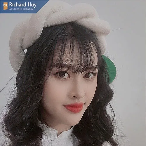 Miệng móm do di truyền Miệng móm do di truyền