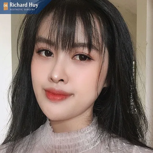 Móm do xương hàm gây ra Móm do xương hàm gây ra