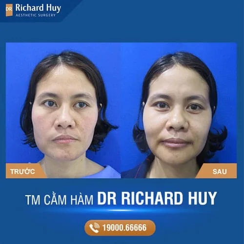 Kết quả đạt được sau quá trình thực hiện độn cằm