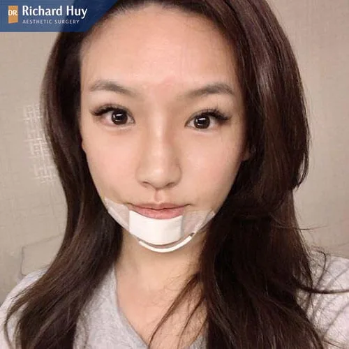 Cằm bị sưng do nhiễm trùng Cằm bị sưng do nhiễm trùng