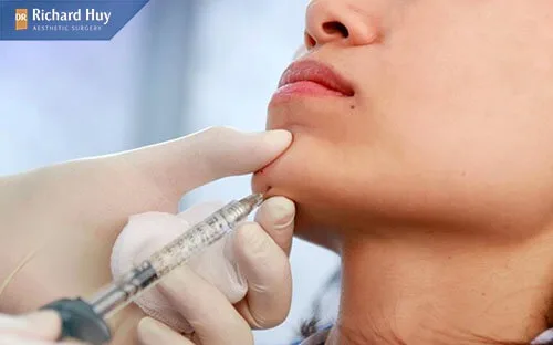 Sử dụng loại filler kém chất lượng khiến cằm bị sưng Sử dụng loại filler kém chất lượng khiến cằm bị sưng