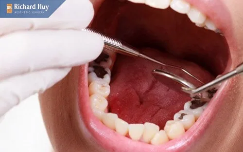 Móm răng còn làm tăng nguy cơ mắc các bệnh về răng miệng Móm răng còn làm tăng nguy cơ mắc các bệnh về răng miệng