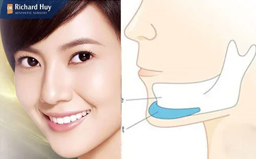 Tháo miếng độn cằm có gây nguy hiểm cho cơ thể không Tháo miếng độn cằm có gây nguy hiểm cho cơ thể không