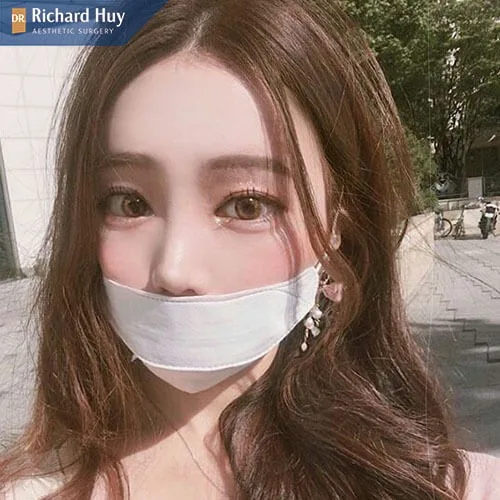 Tiêm cằm ảnh hưởng gì tới sức khỏe Tiêm cằm ảnh hưởng gì tới sức khỏe