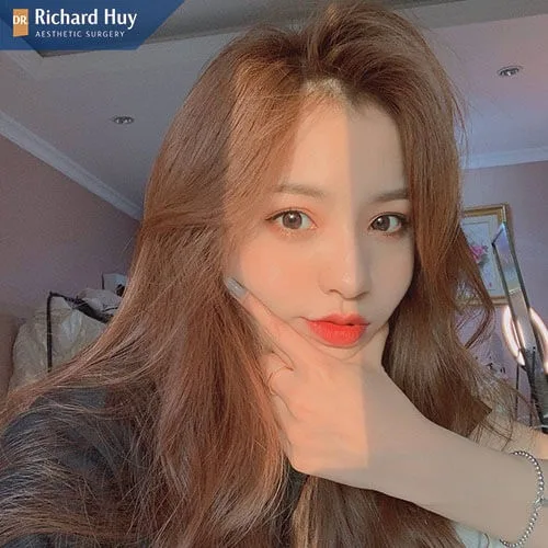 Không sờ nắn và tác động lên vùng cằm sau khi tiêm filler Không sờ nắn và tác động lên vùng cằm sau khi tiêm filler