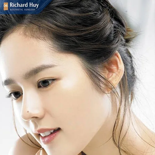 Có 3 loại nâng mũi bán cấu trúc Có 3 loại nâng mũi bán cấu trúc