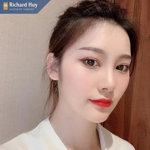 Cách chăm sóc sau khi nâng mũi bán cấu trúc Cách chăm sóc sau khi nâng mũi bán cấu trúc