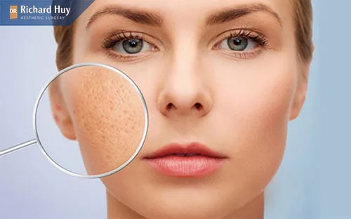 Da mụn và lỗ chân lông to nên thực hiện tái tạo da Da mụn và lỗ chân lông to nên thực hiện tái tạo da