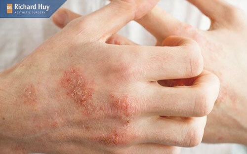 Mắc bệnh Eczema cũng là nguyên nhân khiến da tay nhăn nheo