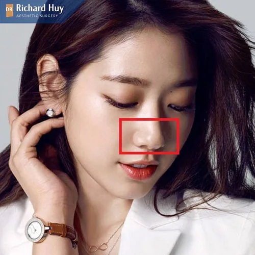 Mũi chẻ là một đặc điểm bẩm sinh có trên gương mặt Mũi chẻ là một đặc điểm bẩm sinh có trên gương mặt