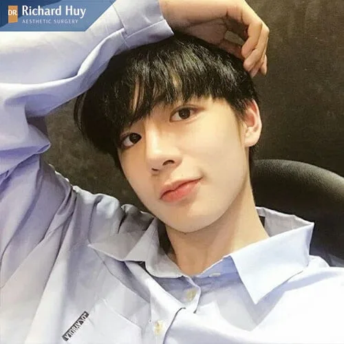 Vơi kĩ thuật nâng mũi ở nam cần độ tỉ mỉ cao hơn Vơi kĩ thuật nâng mũi ở nam cần độ tỉ mỉ cao hơn