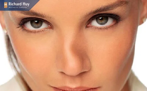 Mũi gãy là đường sống mũi không được thẳng mà trở nên đứt đoạn và gồ ghề Mũi gãy là đường sống mũi không được thẳng mà trở nên đứt đoạn và gồ ghề
