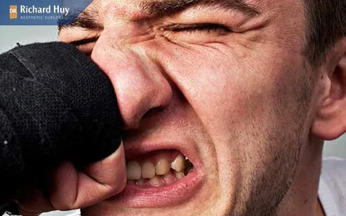 Mũi gãy do va chạm hoặc tai nạn làm xương mũi bị tổn thương Mũi gãy do va chạm hoặc tai nạn làm xương mũi bị tổn thương