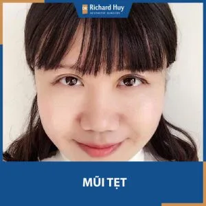 Mũi tẹt thì phải làm sao? Bật mí bí kíp biến MŨI TẸT thành MŨI CAO cực hiệu quả