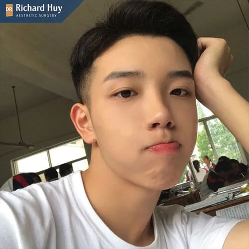 Bạn nam mũi bị vẹo, lệch nên thực hiện nâng mũi Bạn nam mũi bị vẹo, lệch nên thực hiện nâng mũi