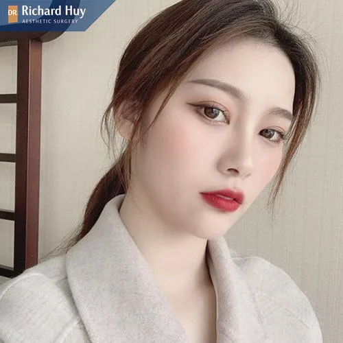 Nâng mũi bán cấu trúc lành sau 2 đến 3 ngày Nâng mũi bán cấu trúc lành sau 2 đến 3 ngày