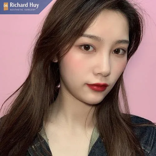 Nâng mũi bán cấu trúc có độ tượng tích với cơ thể rất cao Nâng mũi bán cấu trúc có độ tượng tích với cơ thể rất cao