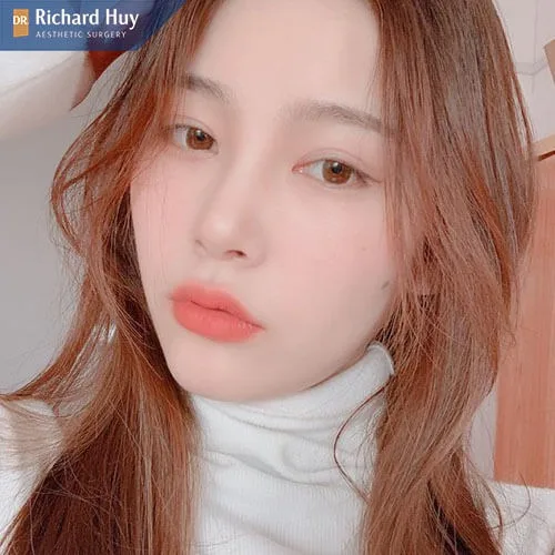 Nâng mũi bán cấu trúc có thể duy trì đến 20 năm Nâng mũi bán cấu trúc có thể duy trì đến 20 năm