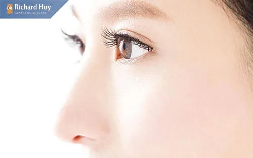 Nâng mũi bán cấu trúc không để lại sẹo hiệu quá duy trì trong thời gian dài Nâng mũi bán cấu trúc không để lại sẹo hiệu quá duy trì trong thời gian dài