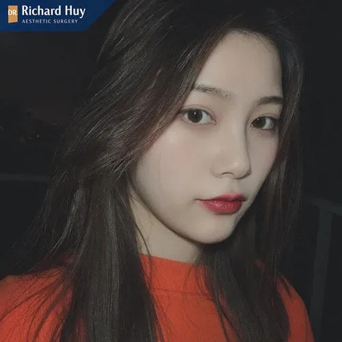 Nâng mũi bán cấu trúc không để lại sẹo Nâng mũi bán cấu trúc không để lại sẹo