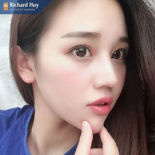 Nâng mũi bán cấu trúc không gây hại cho cơ thể Nâng mũi bán cấu trúc không gây hại cho cơ thể