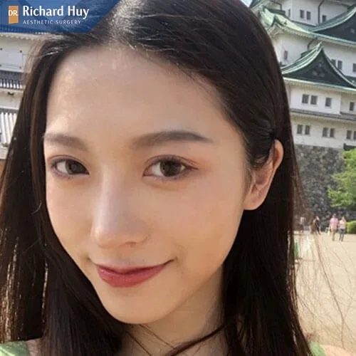 Kỹ thuật nâng mũi không xâm lấn Kỹ thuật nâng mũi không xâm lấn