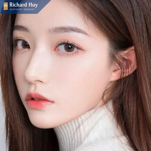 Nâng mũi bán cấu trúc không quá tốn kém Nâng mũi bán cấu trúc không quá tốn kém