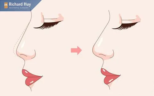 Nâng mũi bán cấu trúc Nâng mũi bán cấu trúc