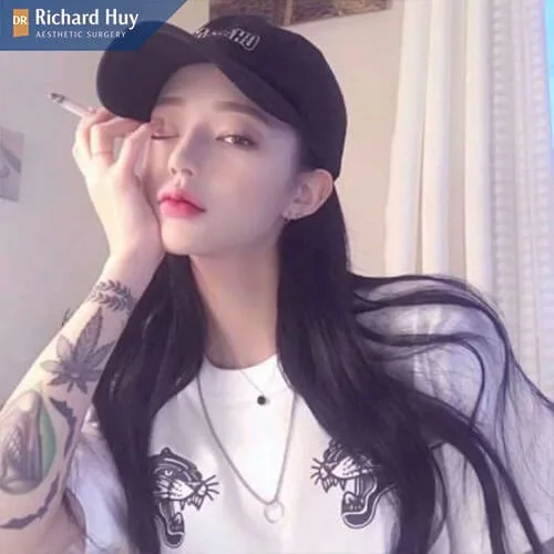 Nâng mũi bọc mụn giúp khắc phục tịnh trạng tụt sống mũi, lệch sụn Nâng mũi bọc mụn giúp khắc phục tịnh trạng tụt sống mũi, lệch sụn