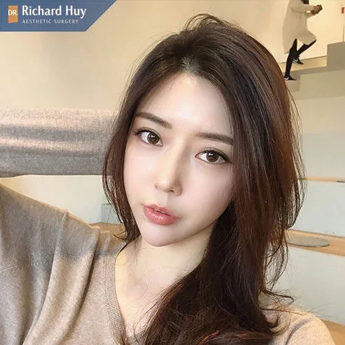 Nâng mũi bọc sụn với sụn tự thân Nâng mũi bọc sụn với sụn tự thân