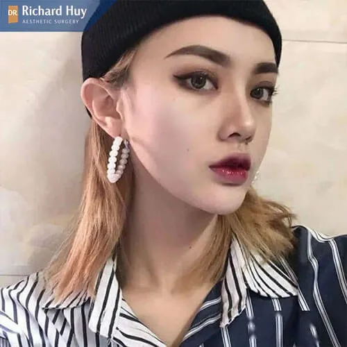 Bọc sụn đầu mũi có thể duy trì được trong vòng 15-20 năm Bọc sụn đầu mũi có thể duy trì được trong vòng 15-20 năm