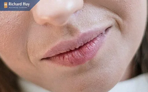 Thiếu nước cũng là nguyên nhân gây nếp nhăn khóe miệng Thiếu nước cũng là nguyên nhân gây nếp nhăn khóe miệng