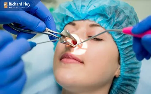 Phẫu thuật chỉnh hình mũi lệch Phẫu thuật chỉnh hình mũi lệch