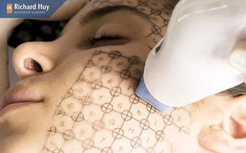 Tiến hành liệu trình Thermage FLX Tiến hành liệu trình Thermage FLX