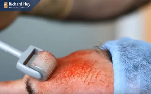 Tái tạo da với phương pháp lăn kim có thể gây sưng phù nề khuân mặt Tái tạo da với phương pháp lăn kim có thể gây sưng phù nề khuân mặt