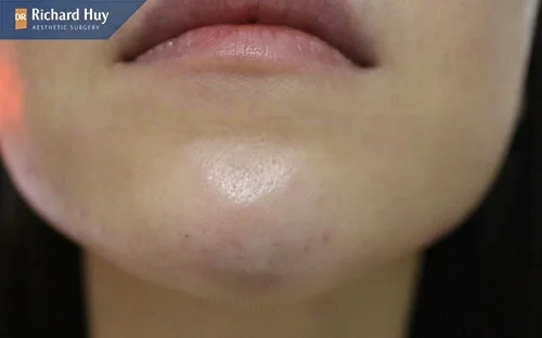 Sau khi tiêm filler cằm bị bầm tím có nguy hiểm không