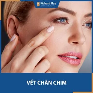 TOP 17 phương pháp giúp thổi bay vết chân chim ngay tức khắc