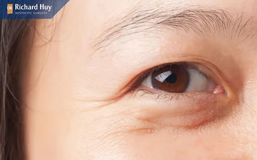 Vết chân chim suất hiện quanh mắt