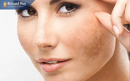 Vi kim tảo biển gây tác hại như mụn ẩn và thâm da
