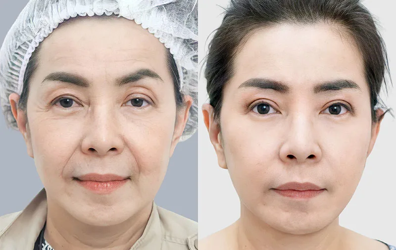 Khách hàng trước và sau khi căng da mặt