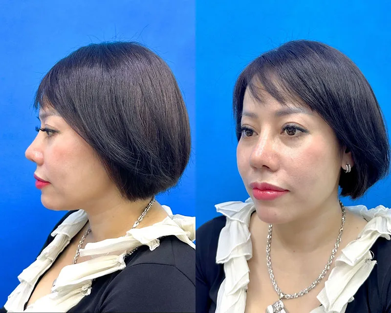 Dáng mũi cao bay tự nhiên của chị Phương sau khi sửa lại