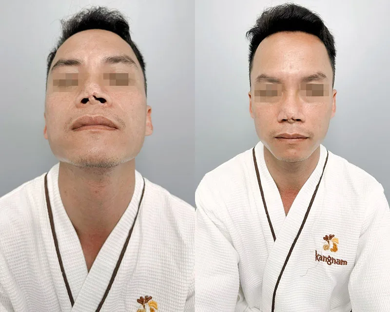 Mũi hỏng, lệch vẹo do tai nạn