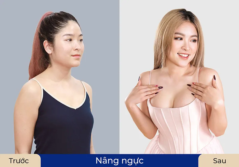 Người có vòng một nhỏ, lép và khiêm tốn nên cân nhắc nâng ngực