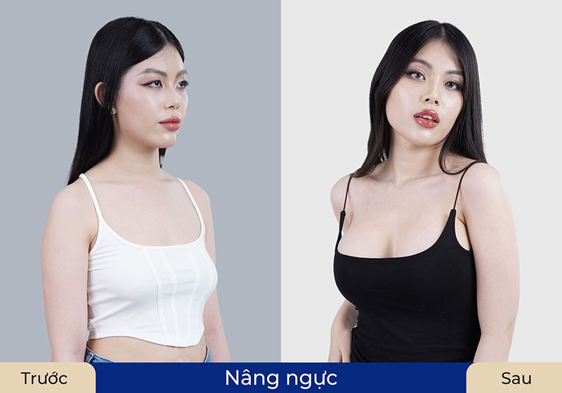 Nâng ngực là phương pháp cải thiện hình dáng, kích thước vòng 1