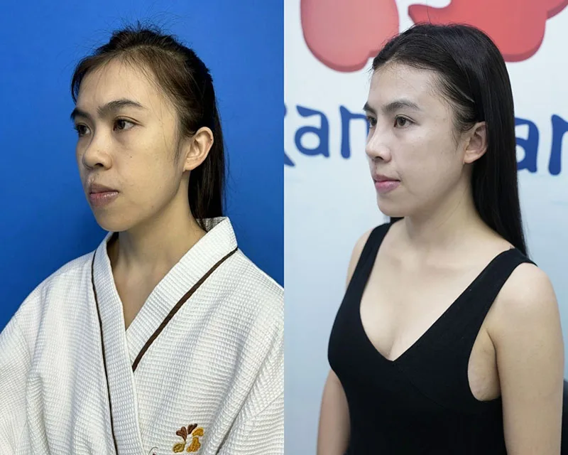 Dáng mũi của Thanh Tâm trước và sau khi phẫu thuật