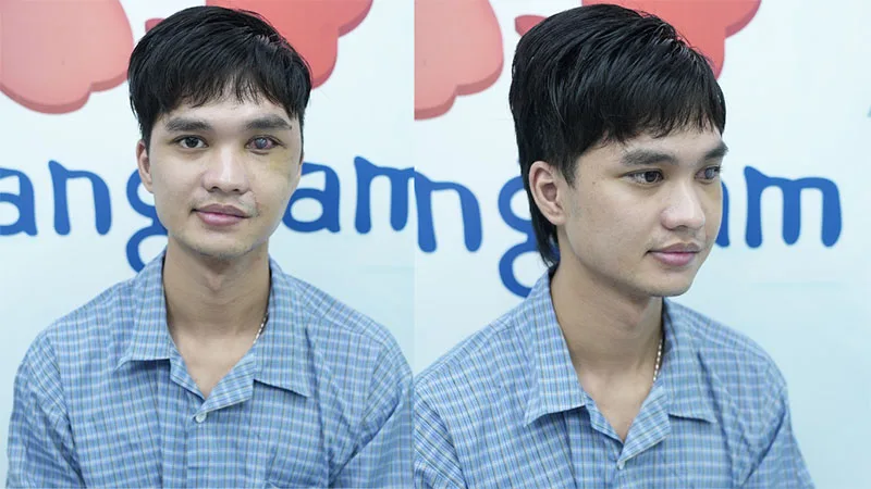 Sau khi được TS.BS.Richard Huy phẫu thuật Toàn đã có thể khép mắt được