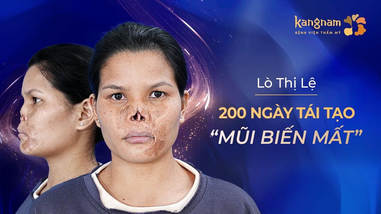 200 ngày tái tạo mũi cho 